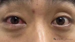 男子遇五步蛇想抓来玩被喷一脸毒